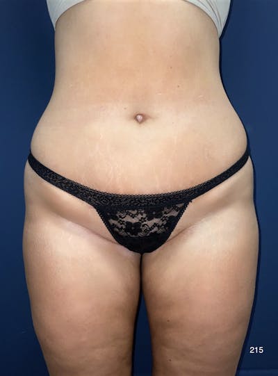 Liposuction Before & After Gallery - Patient 380684 - Image 2