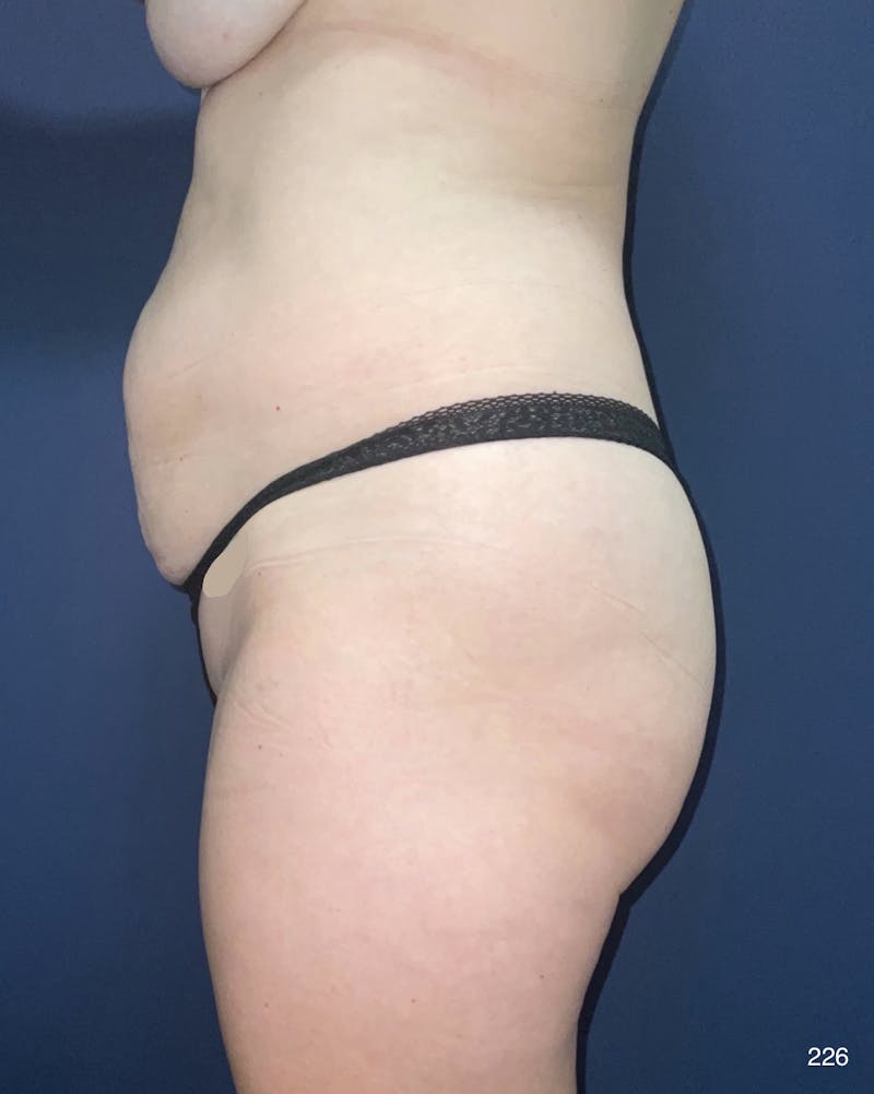 Tummy Tuck Before & After Gallery - Patient 398798 - Image 3