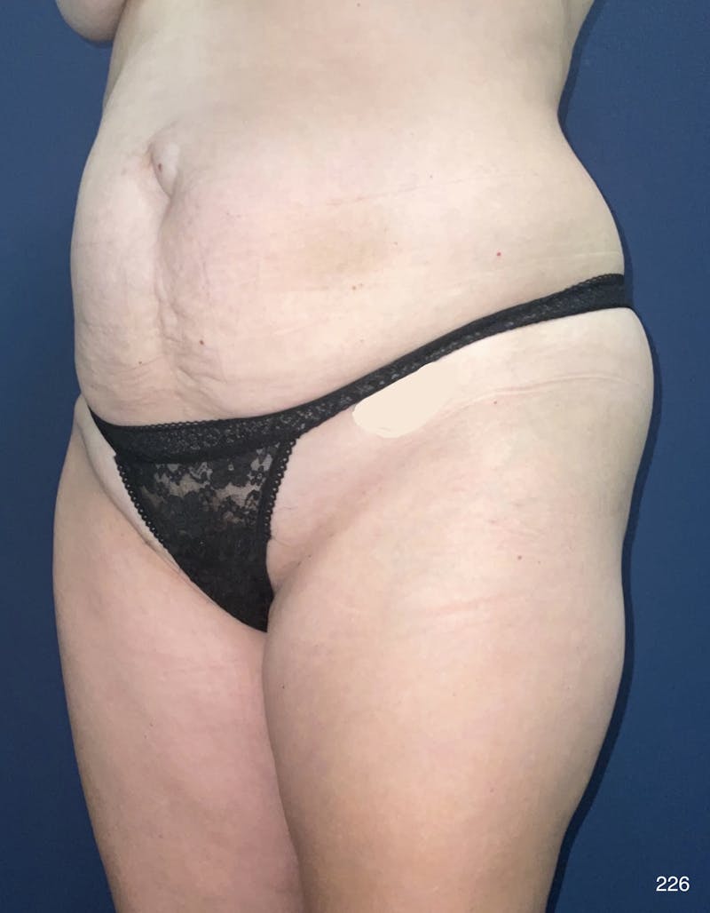 Tummy Tuck Before & After Gallery - Patient 398798 - Image 7