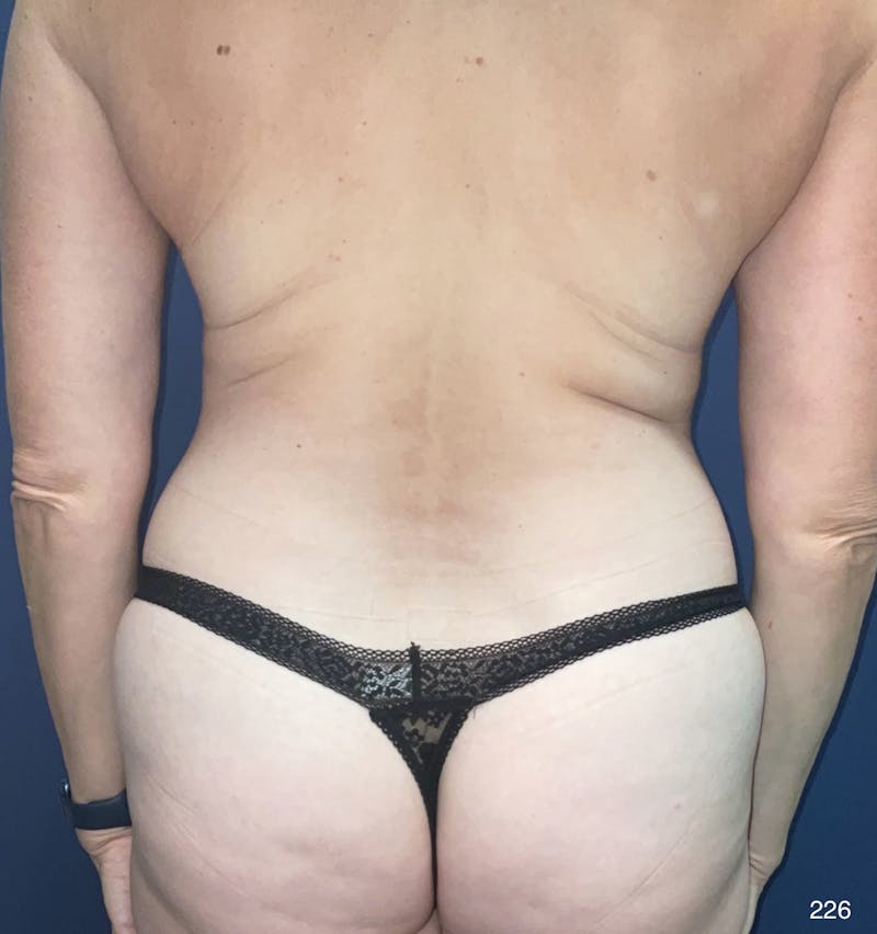 Tummy Tuck Before & After Gallery - Patient 398798 - Image 5