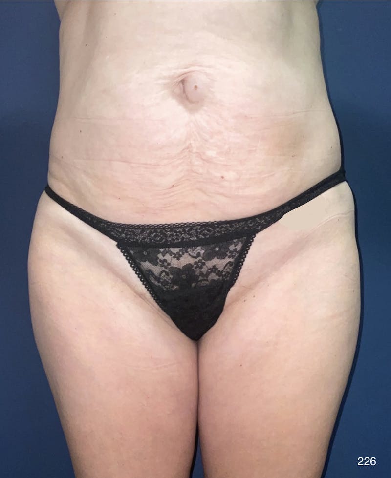 Liposuction Before & After Gallery - Patient 925535 - Image 1
