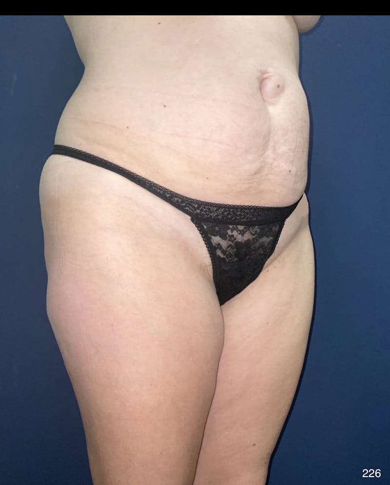 Tummy Tuck Before & After Gallery - Patient 398798 - Image 9