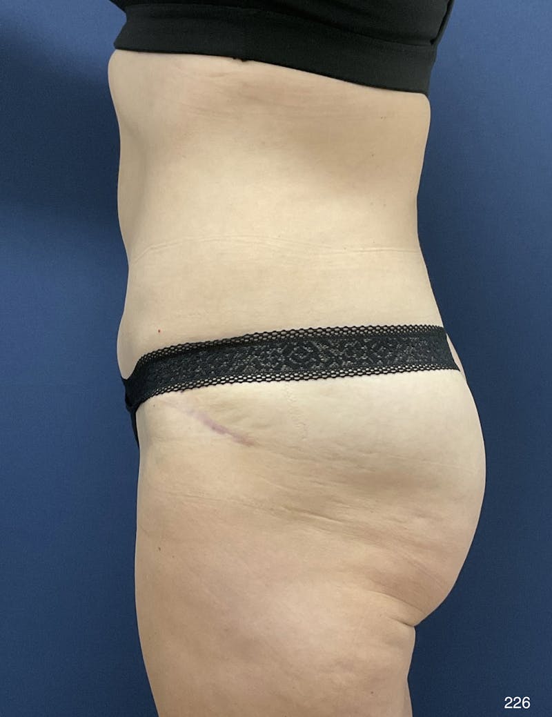 Liposuction Before & After Gallery - Patient 925535 - Image 4