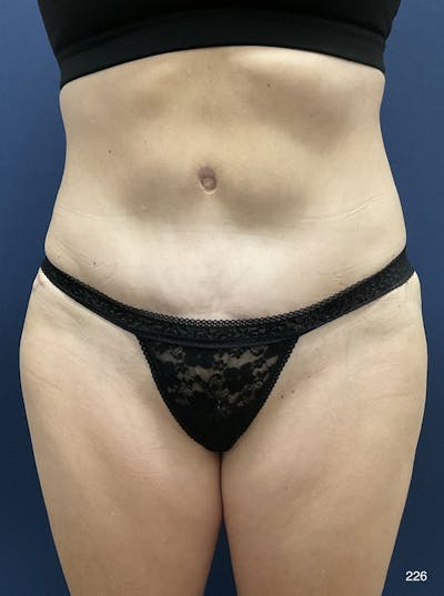Tummy Tuck Before & After Gallery - Patient 398798 - Image 2