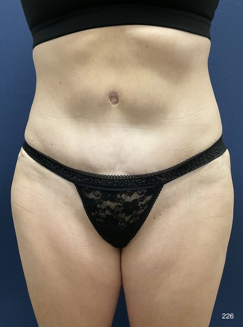 Liposuction Before & After Gallery - Patient 925535 - Image 2