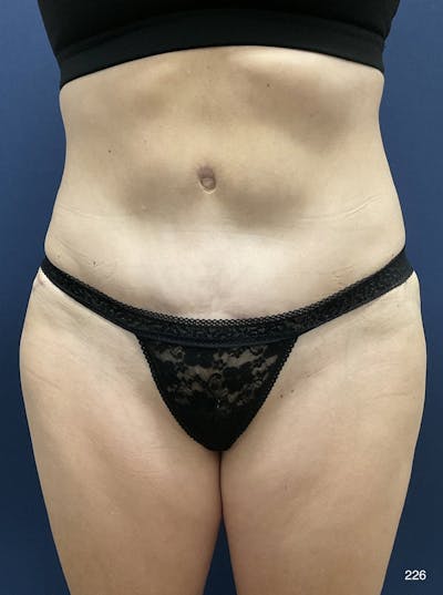 BodyTite/MorpheusBody Before & After Gallery - Patient 409224 - Image 2