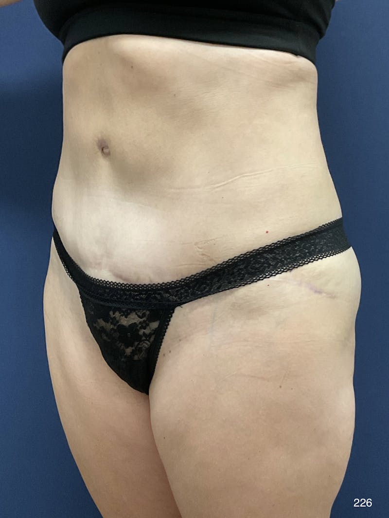 Tummy Tuck Before & After Gallery - Patient 398798 - Image 8
