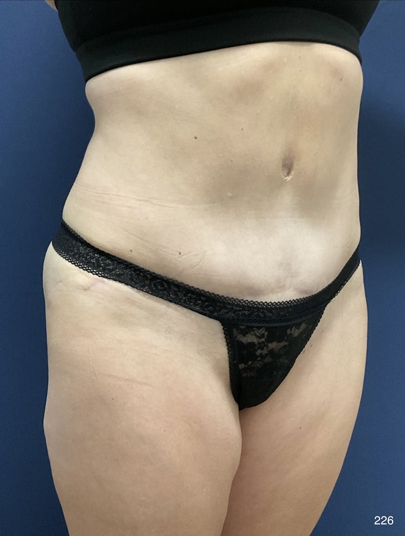 Tummy Tuck Before & After Gallery - Patient 398798 - Image 10