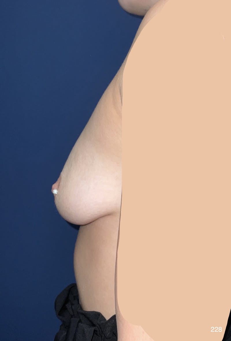 Breast Augmentation with Lift Before & After Gallery - Patient 982874 - Image 3