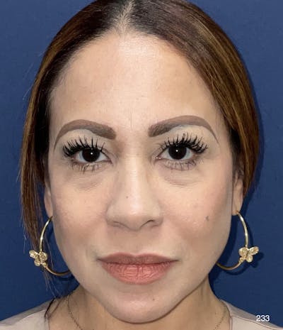 Blepharoplasty Before & After Gallery - Patient 424147 - Image 1