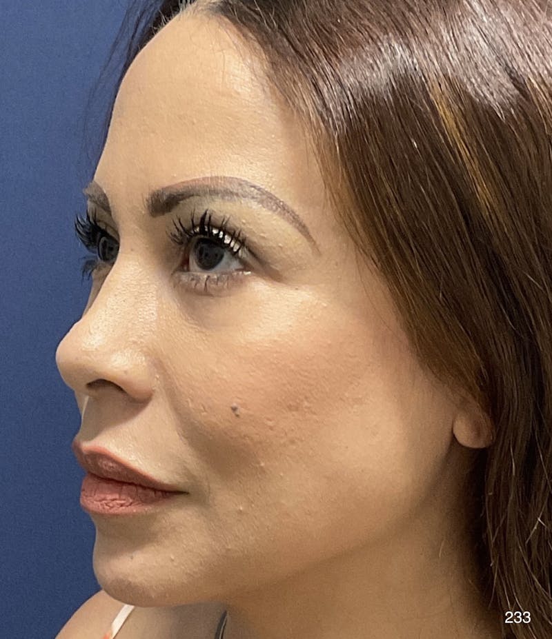 Blepharoplasty Before & After Gallery - Patient 424147 - Image 4