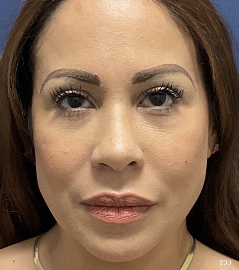 Blepharoplasty Before & After Gallery - Patient 424147 - Image 2