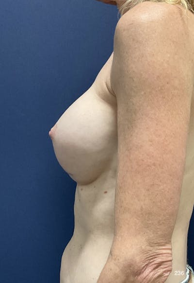 Capsulectomy Implant Exchange Before & After Gallery - Patient 410739 - Image 1