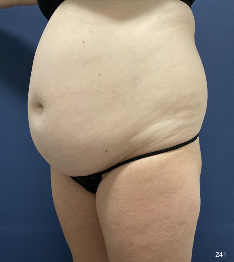 Tummy Tuck Before & After Gallery - Patient 198922 - Image 7