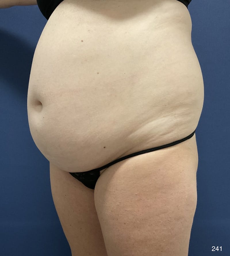 Tummy Tuck Before & After Gallery - Patient 198922 - Image 3