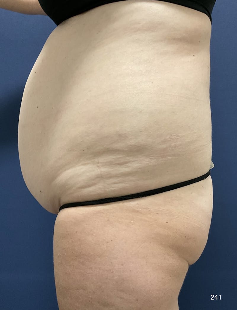 Tummy Tuck Before & After Gallery - Patient 198922 - Image 3