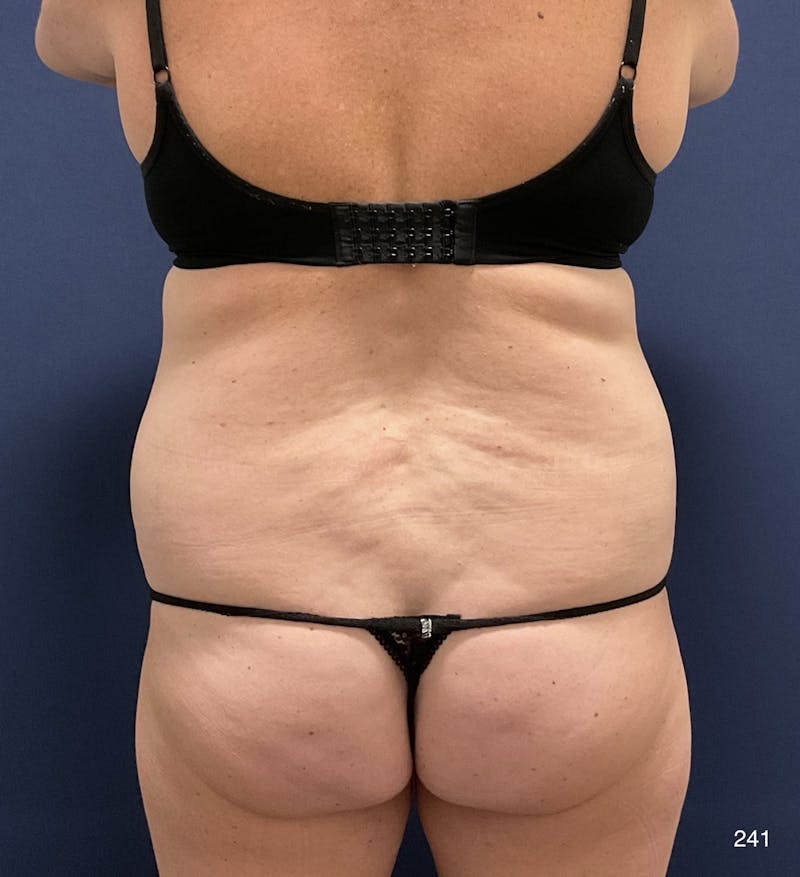 Tummy Tuck Before & After Gallery - Patient 198922 - Image 7