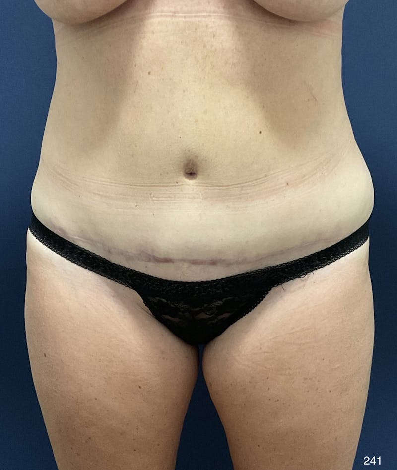 Tummy Tuck Before & After Gallery - Patient 198922 - Image 2
