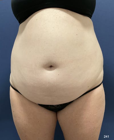 Tummy Tuck Before & After Gallery - Patient 198922 - Image 1