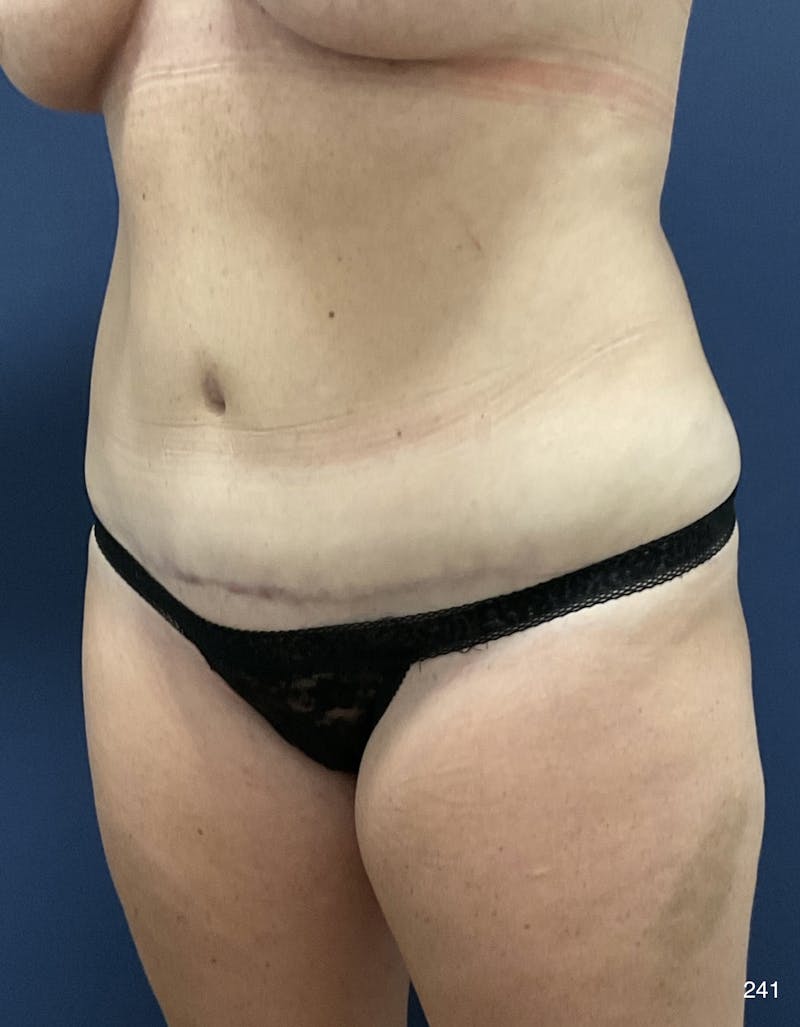 Liposuction Before & After Gallery - Patient 362384 - Image 4
