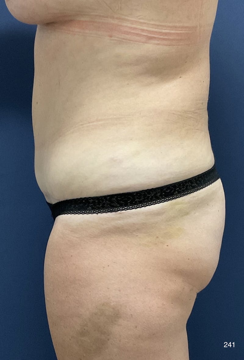 Liposuction Before & After Gallery - Patient 362384 - Image 6