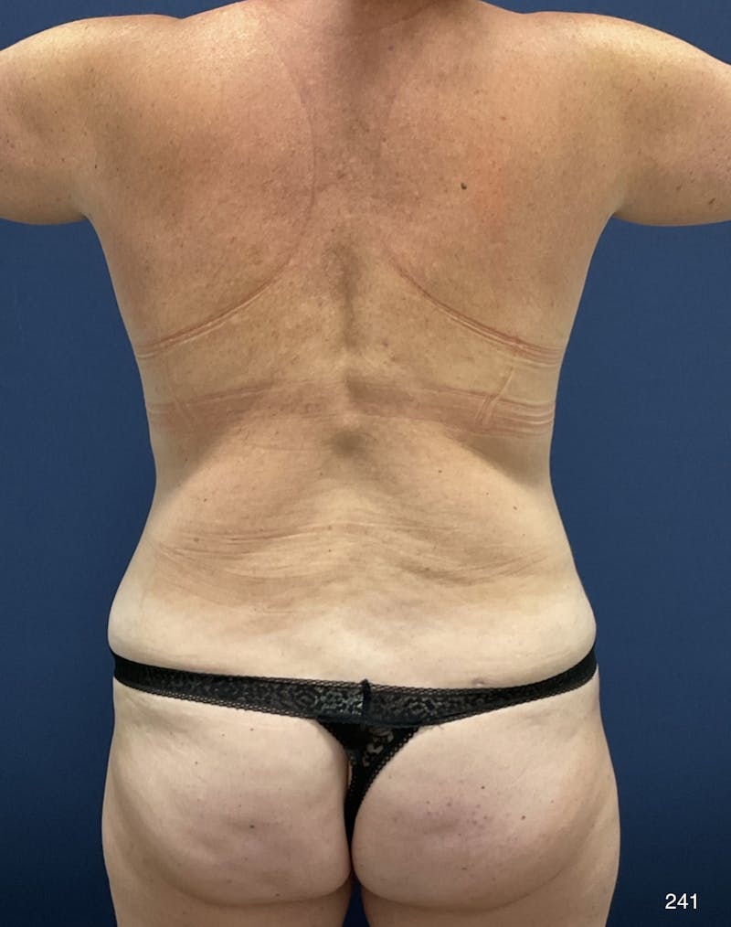 Tummy Tuck Before & After Gallery - Patient 198922 - Image 6