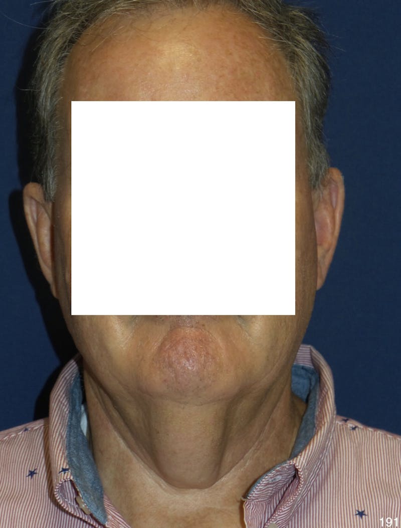 Neck Lift Before & After Gallery - Patient 185939 - Image 1