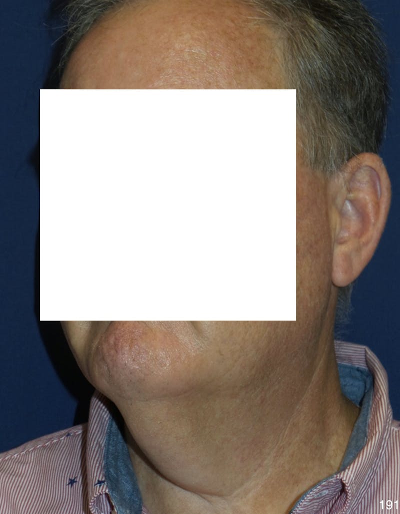 Neck Lift Before & After Gallery - Patient 185939 - Image 3