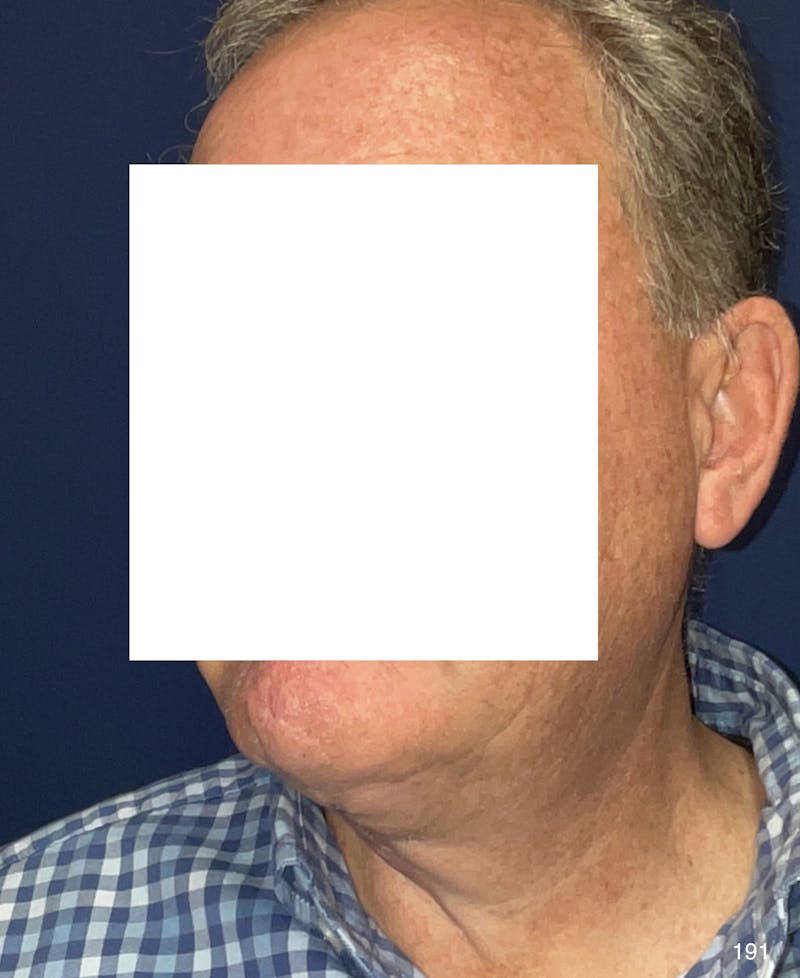 Neck Lift Before & After Gallery - Patient 185939 - Image 4