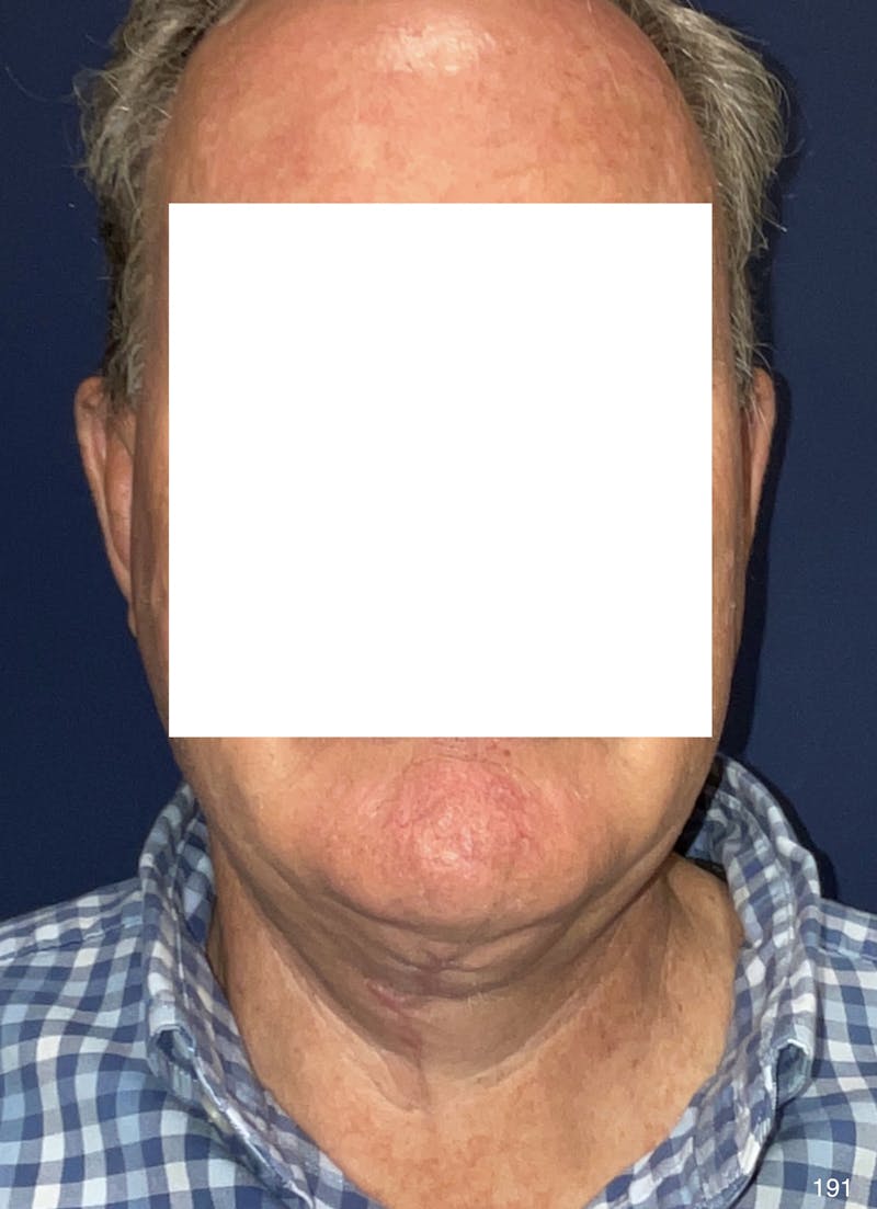 Neck Lift Before & After Gallery - Patient 185939 - Image 2