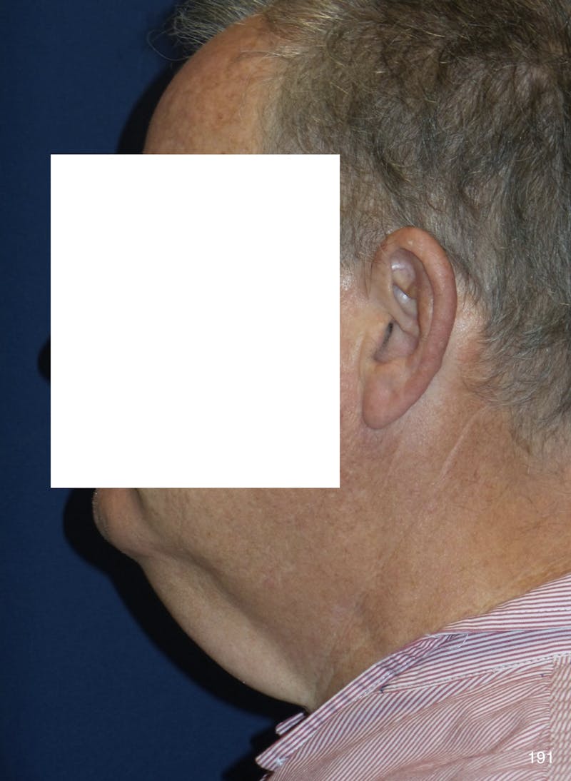 Neck Lift Before & After Gallery - Patient 185939 - Image 5