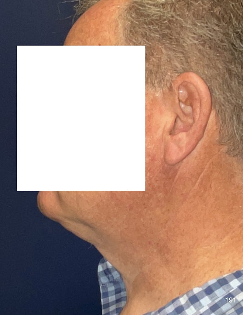 Neck Lift Before & After Gallery - Patient 185939 - Image 6