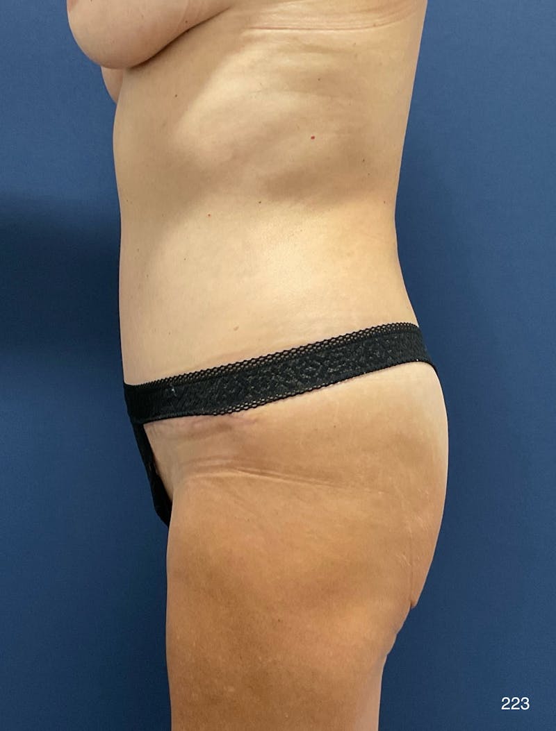 Tummy Tuck Before & After Gallery - Patient 309015 - Image 4