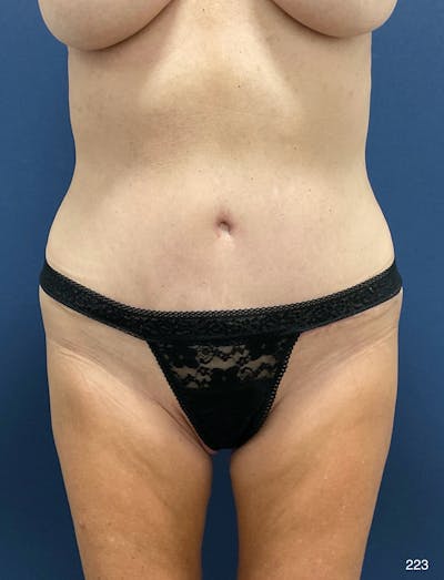 Tummy Tuck Before & After Gallery - Patient 309015 - Image 2