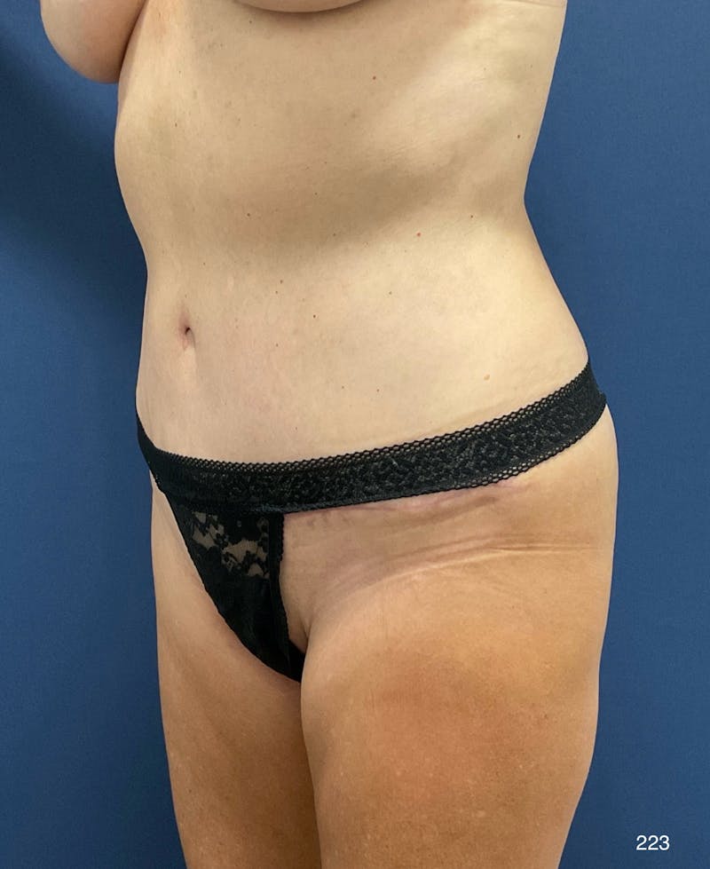 Tummy Tuck Before & After Gallery - Patient 309015 - Image 6