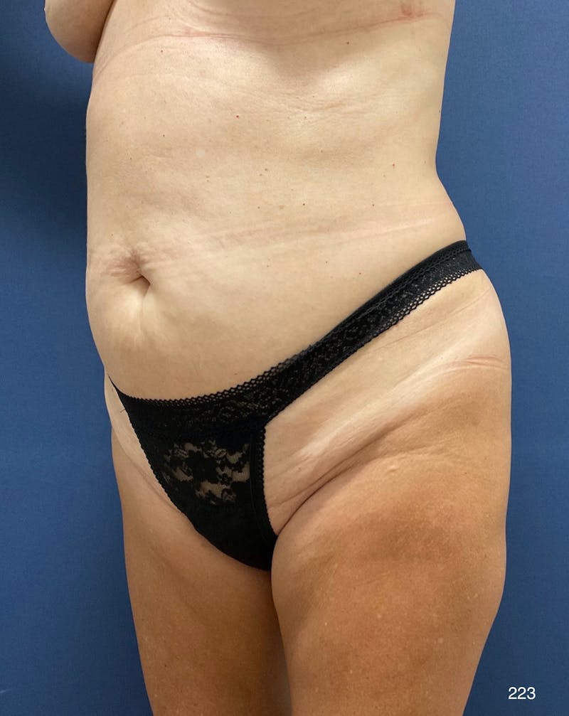 Tummy Tuck Before & After Gallery - Patient 309015 - Image 5