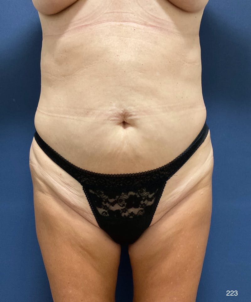 Tummy Tuck Before & After Gallery - Patient 309015 - Image 1