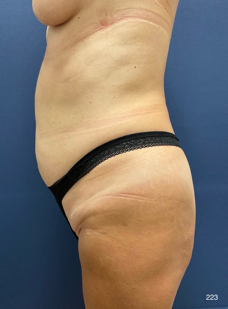 Tummy Tuck Before & After Gallery - Patient 309015 - Image 3