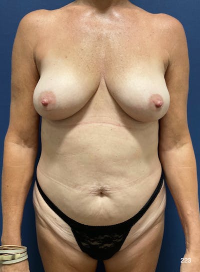 Mommy Makeover Before & After Gallery - Patient 353129 - Image 1