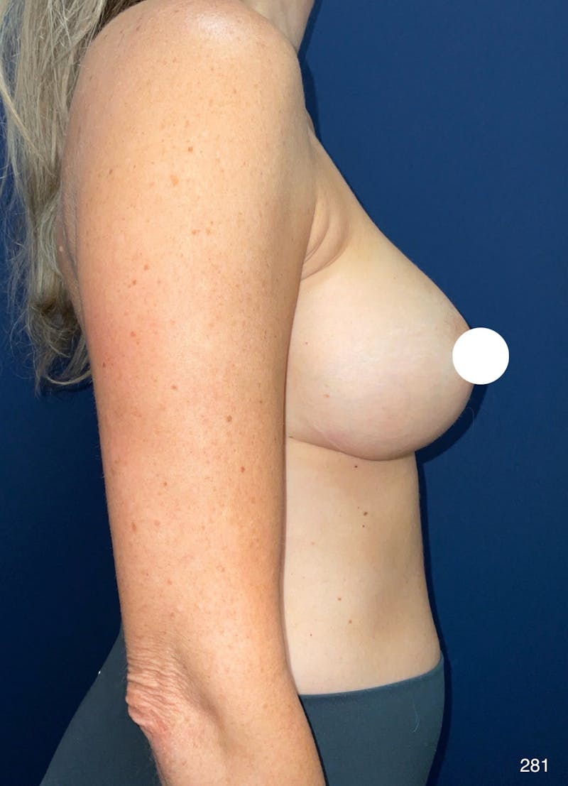 Capsulectomy Implant Exchange Before & After Gallery - Patient 403742 - Image 4