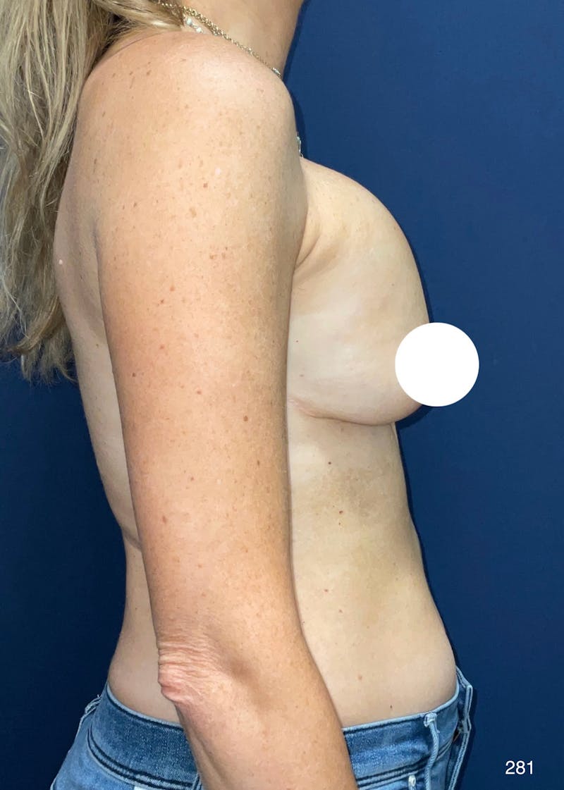 Capsulectomy Implant Exchange Before & After Gallery - Patient 403742 - Image 3