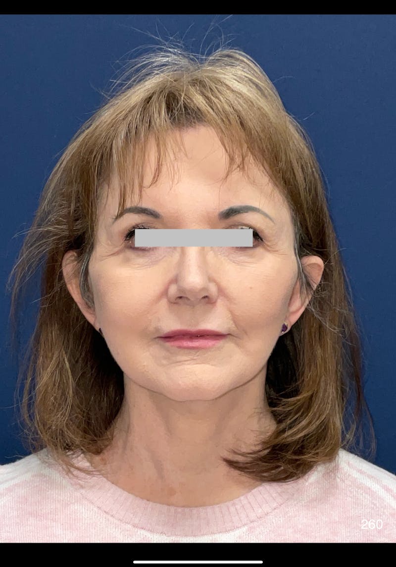 Facelift Before & After Gallery - Patient 286013 - Image 2