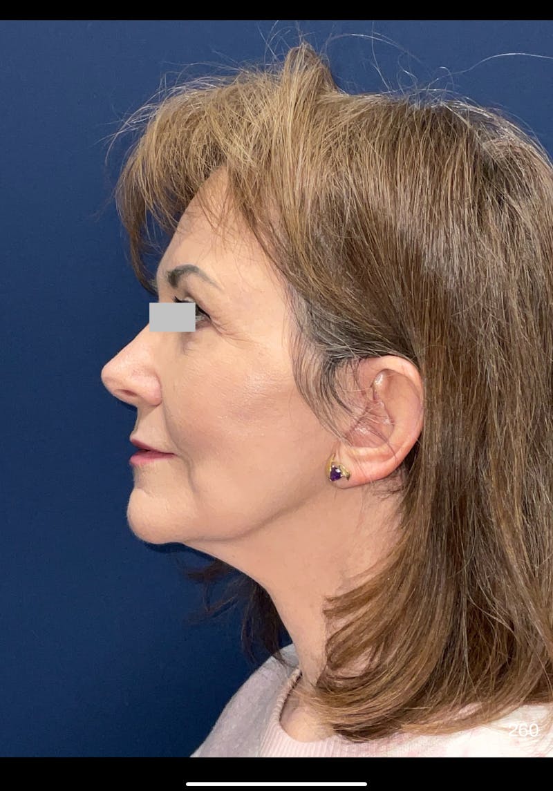 Facelift Before & After Gallery - Patient 286013 - Image 6