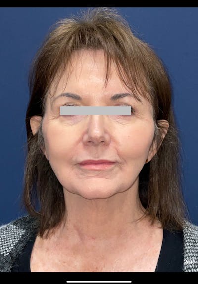 Neck Lift Before & After Gallery - Patient 273393 - Image 1