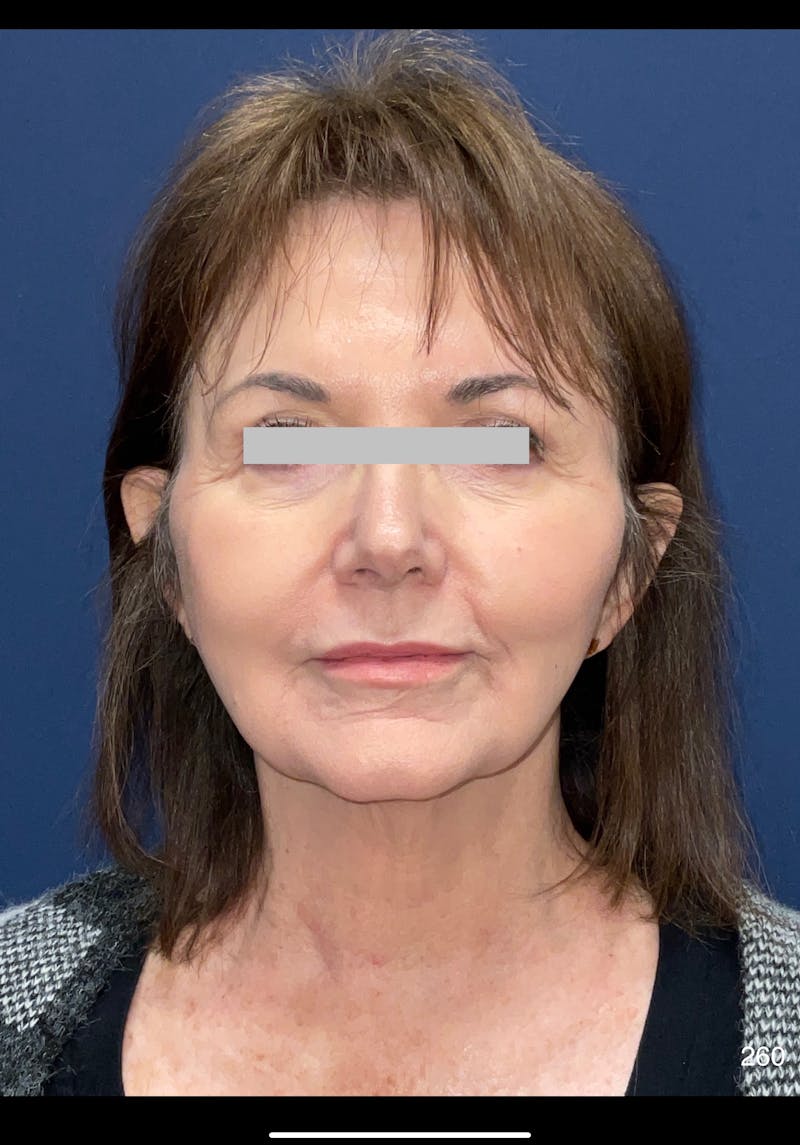 Neck Lift Before & After Gallery - Patient 273393 - Image 1