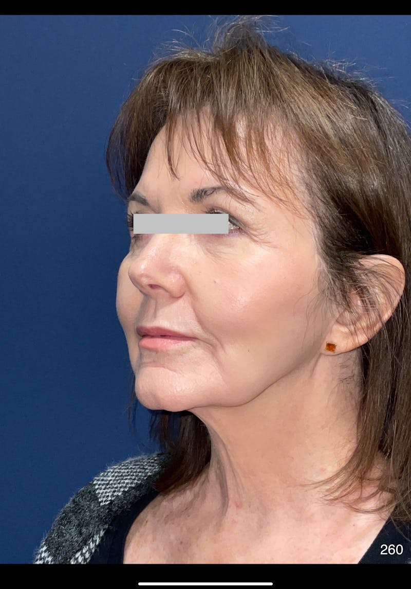 Facelift Before & After Gallery - Patient 286013 - Image 4