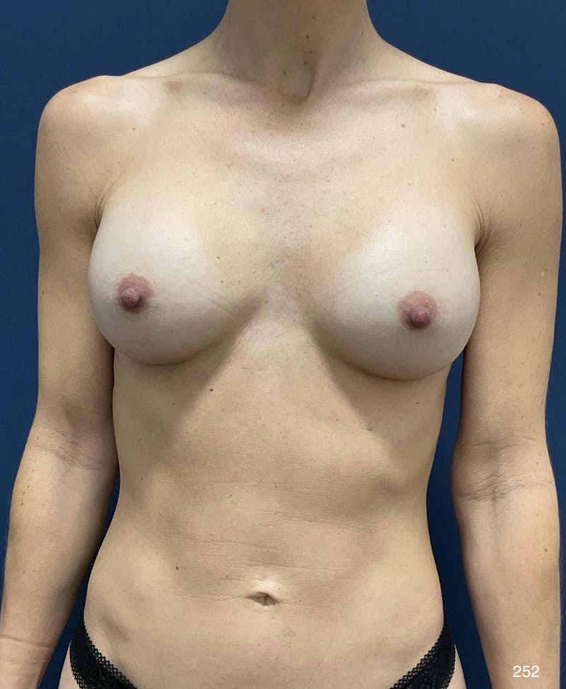 Breast Augmentation Before & After Gallery - Patient 314891 - Image 2
