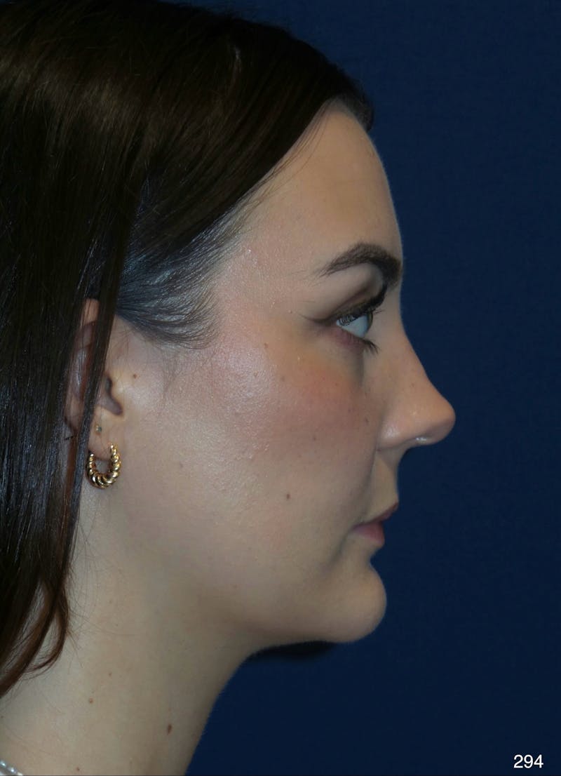 Rhinoplasty Before & After Gallery - Patient 387364 - Image 4