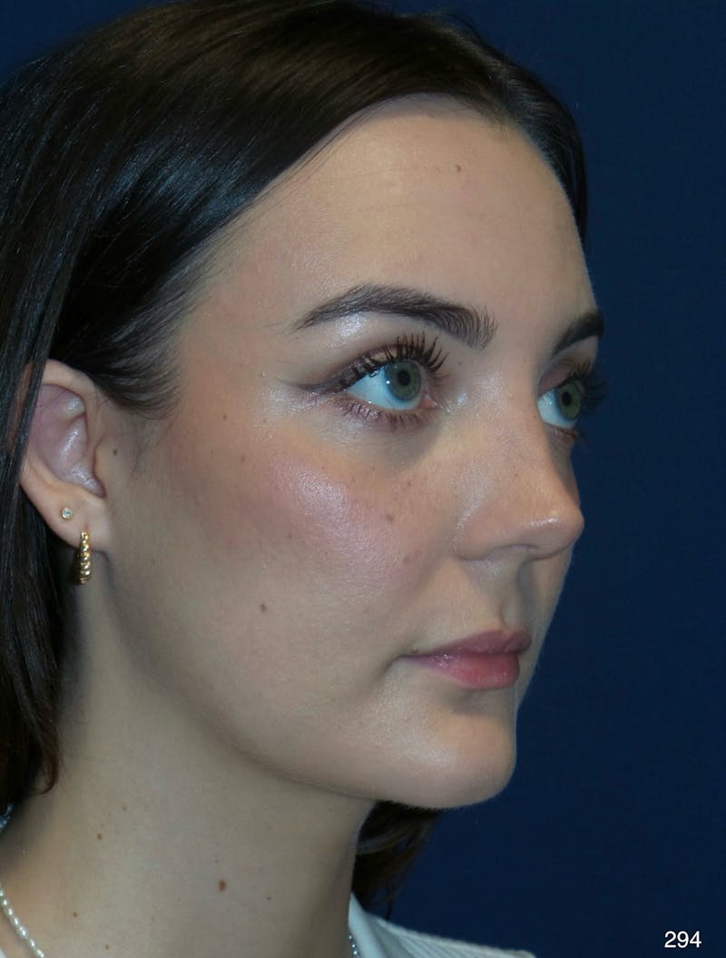 Rhinoplasty Before & After Gallery - Patient 387364 - Image 6