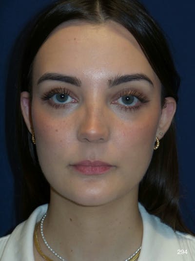 Rhinoplasty Before & After Gallery - Patient 387364 - Image 2